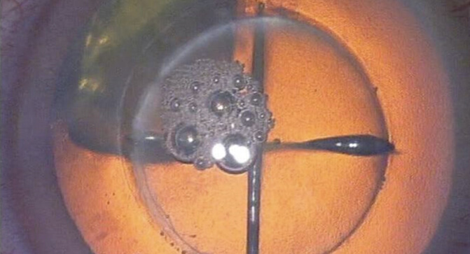 Cataract Removal Treatment