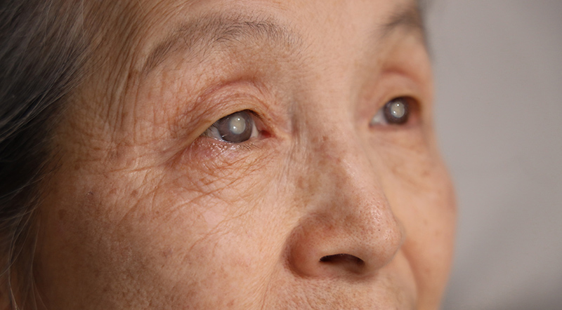 Is Cataract Surgery Safe for the Elderly?